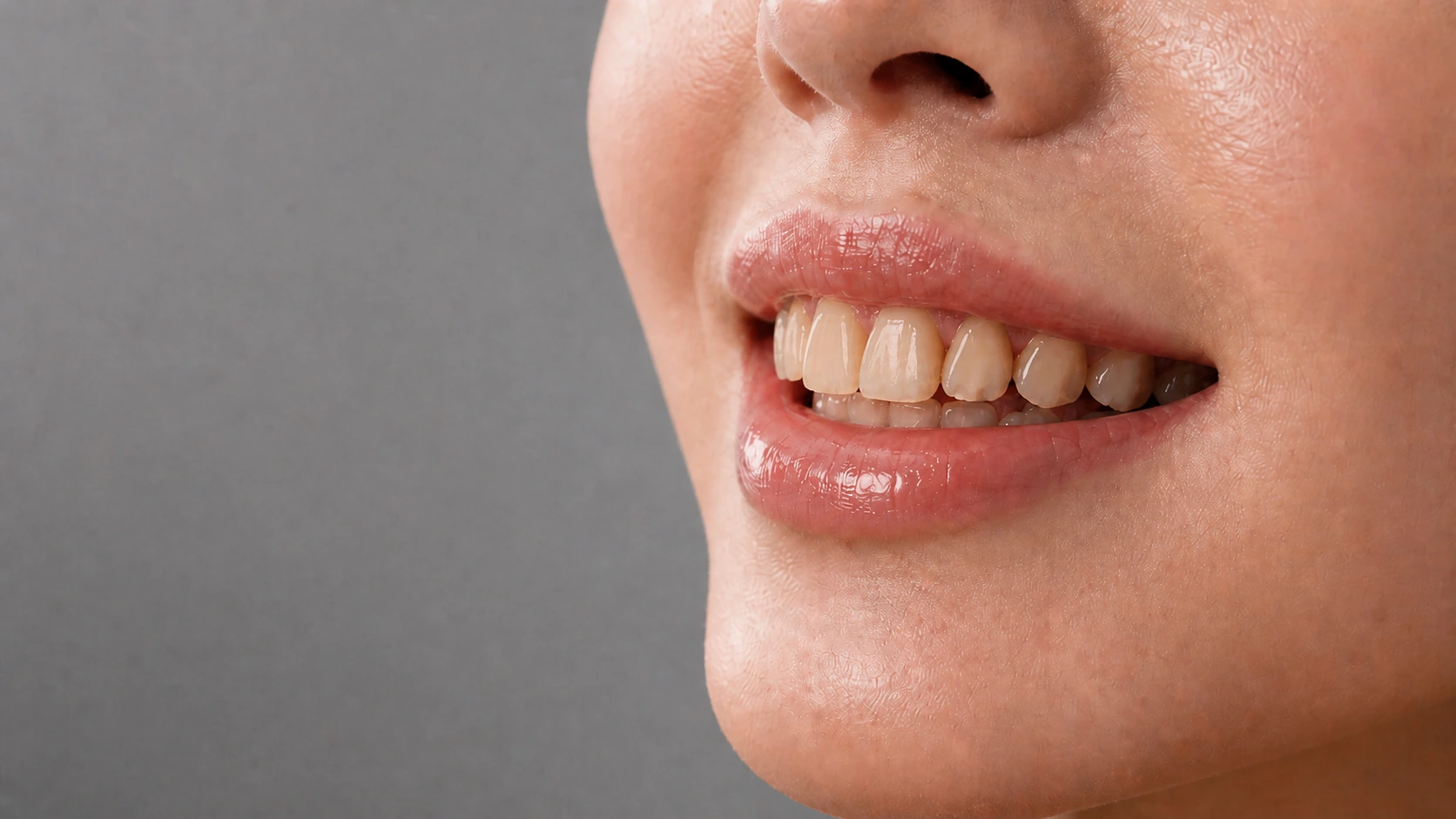 贴片前牙齿发黄、形态欠佳、切端磨损与轻微牙缝 / Before veneers with discoloration, uneven shape, worn edges and small gaps